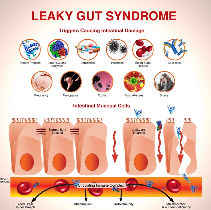 Leaky Gut Syndrome (LGS)